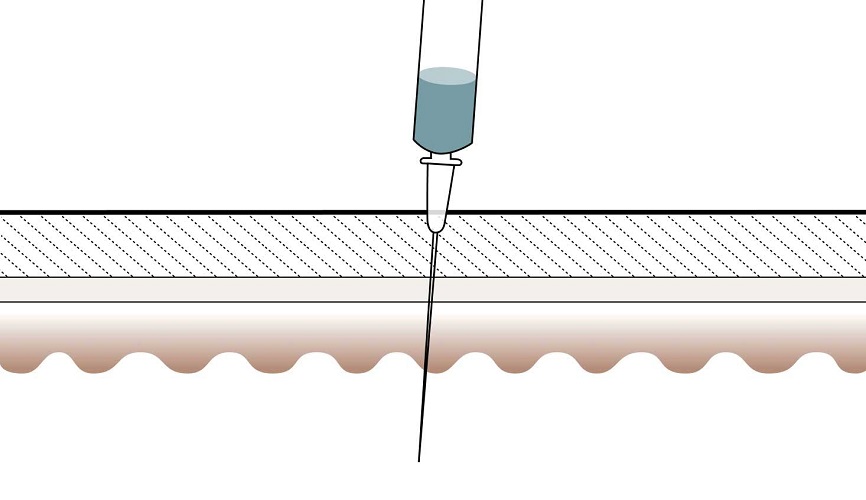 Botox - How it works - Step 1