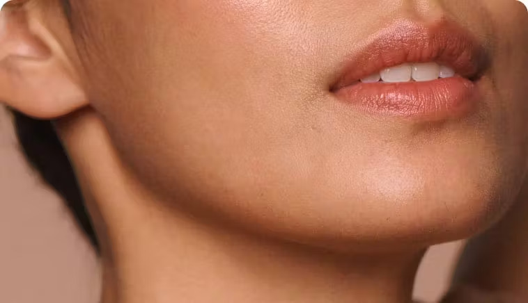 kybella - lips photo